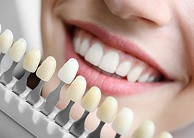 dentist color-matching veneers in Rochester