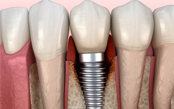 Illustration showing infection around a dental implant